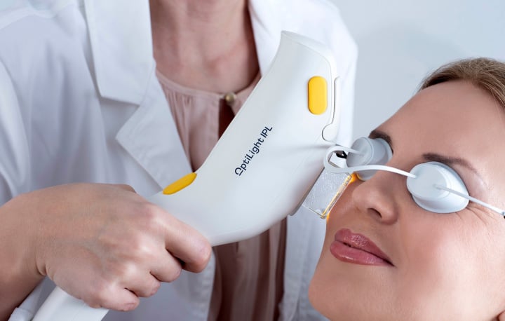 Patient receiving dry eye treatment with OptiLight by Lumenis
